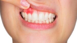 Periodontitis, Penyakit Gusi yang Tidak Bisa Disepelekan