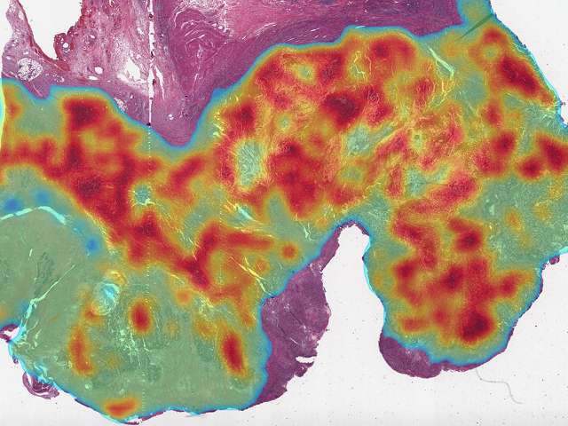 Algoritme pembelajaran mendalam baru dapat mengambil mutasi genetik dan defisiensi perbaikan ketidakcocokan DNA pada kanker kolorektal dengan lebih efisien