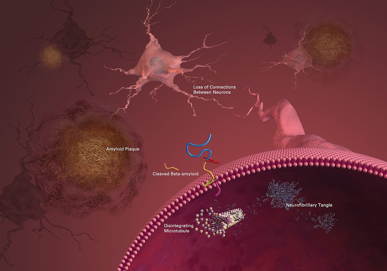 Para ilmuwan menciptakan otak kecil untuk mencari pengobatan potensial Alzheimer – Majalah Time.com