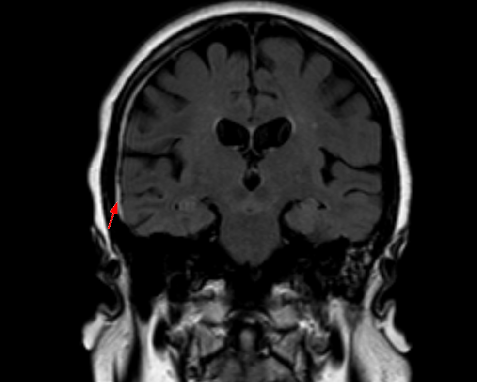 Tidak, obesitas tidak melindungi Anda dari perdarahan subarachnoid – Majalah Time.com